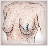 Уменьшение груди T-образным швом